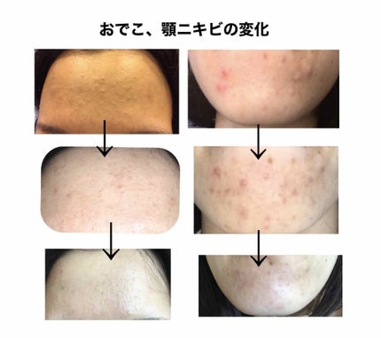 ACアクティブ フェイスローション モイスト/NOV/化粧水を使ったクチコミ(2枚目)