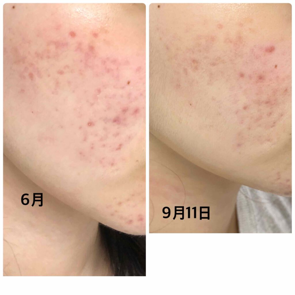 ニキビあとケアジェル/アットノン/その他スキンケアを使ったクチコミ(2枚目)