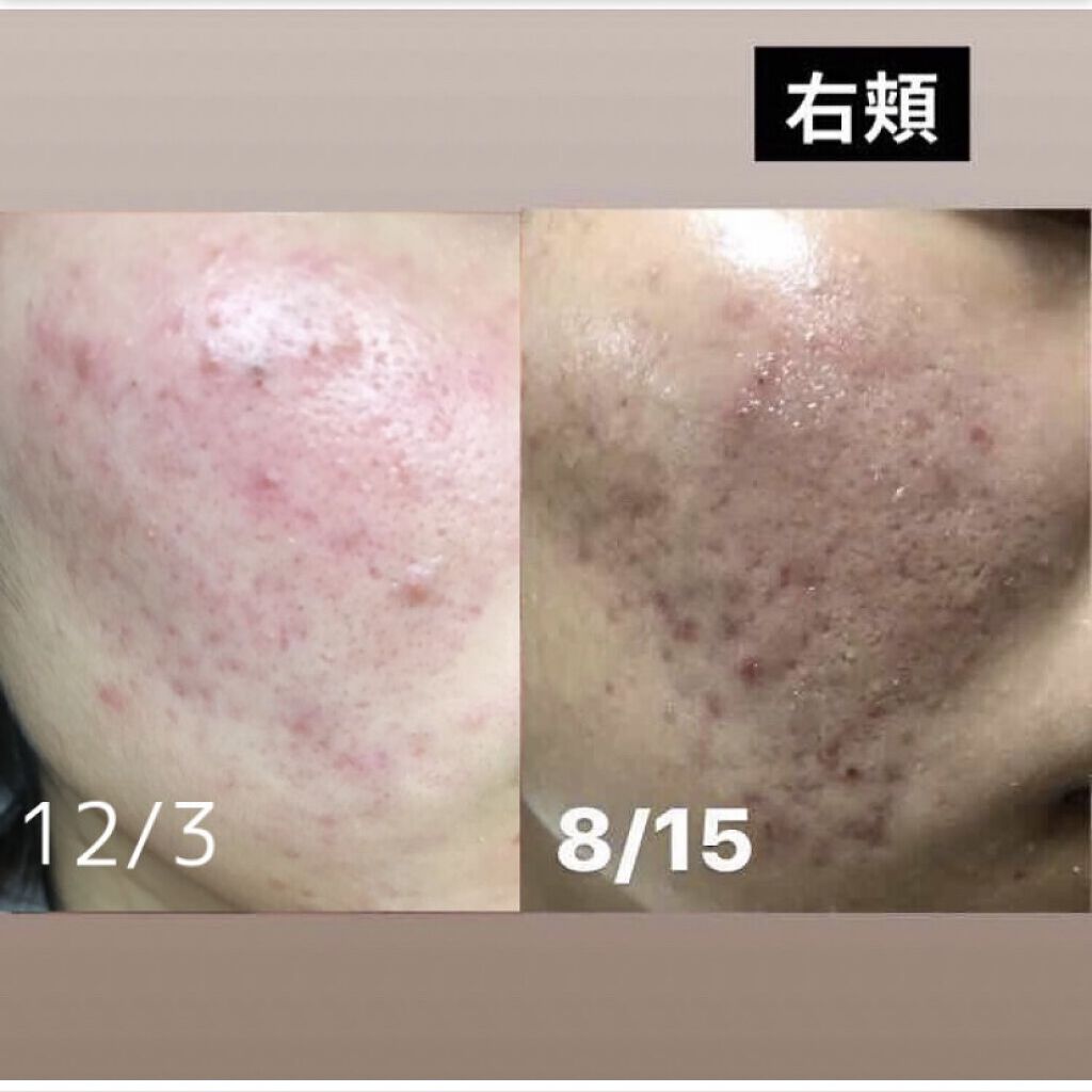 コレクチム軟膏0.5% (医薬品)/鳥居薬品/その他を使ったクチコミ（3枚目）