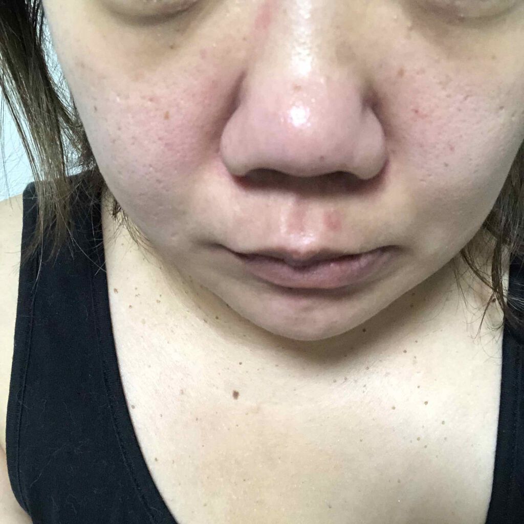 ♡みやび♡ on LIPS 「自分へのご褒美に毛穴汚れ吸引器買いました♡届いて使ってみたとこ..」(2枚目)