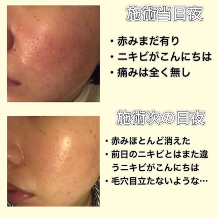 ハイコンセントレイト VC ミスト/&be/ミスト状化粧水を使ったクチコミ(3枚目)
