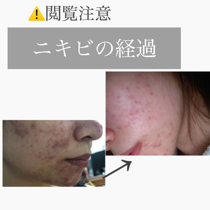 集中対策 マスク/メラノCC/シートマスク・パックを使ったクチコミ(1枚目)