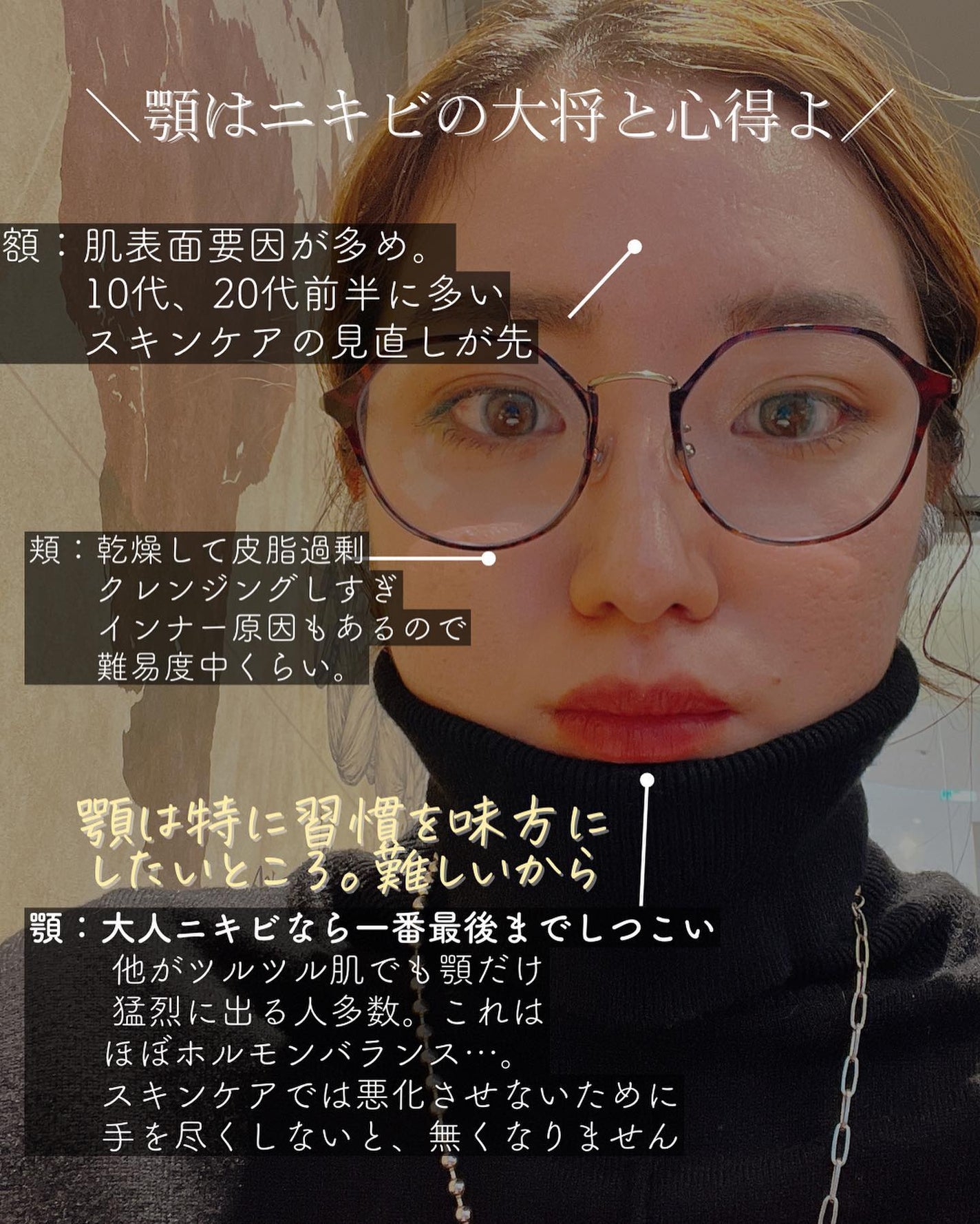 おゆみ|ニキビ・ニキビ跡ケア on LIPS 「【無意識に触ってない?】これに尽きる…!私もそうだったのですが..」(5枚目)