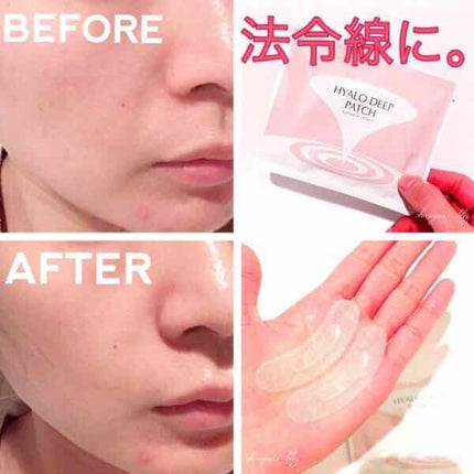 ヒアロディープパッチ/北の快適工房/シートマスク・パックを使ったクチコミ(1枚目)