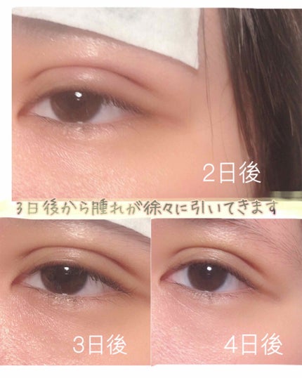 アイテープ(絆創膏タイプ、レギュラー、70枚)/DAISO/二重まぶた用アイテムを使ったクチコミ(3枚目)