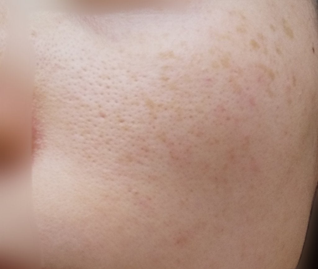 supreme_cosme_icfr on LIPS 「どなたか助けてください……頬の毛穴の開きがずっと治りません😢頬..」(2枚目)