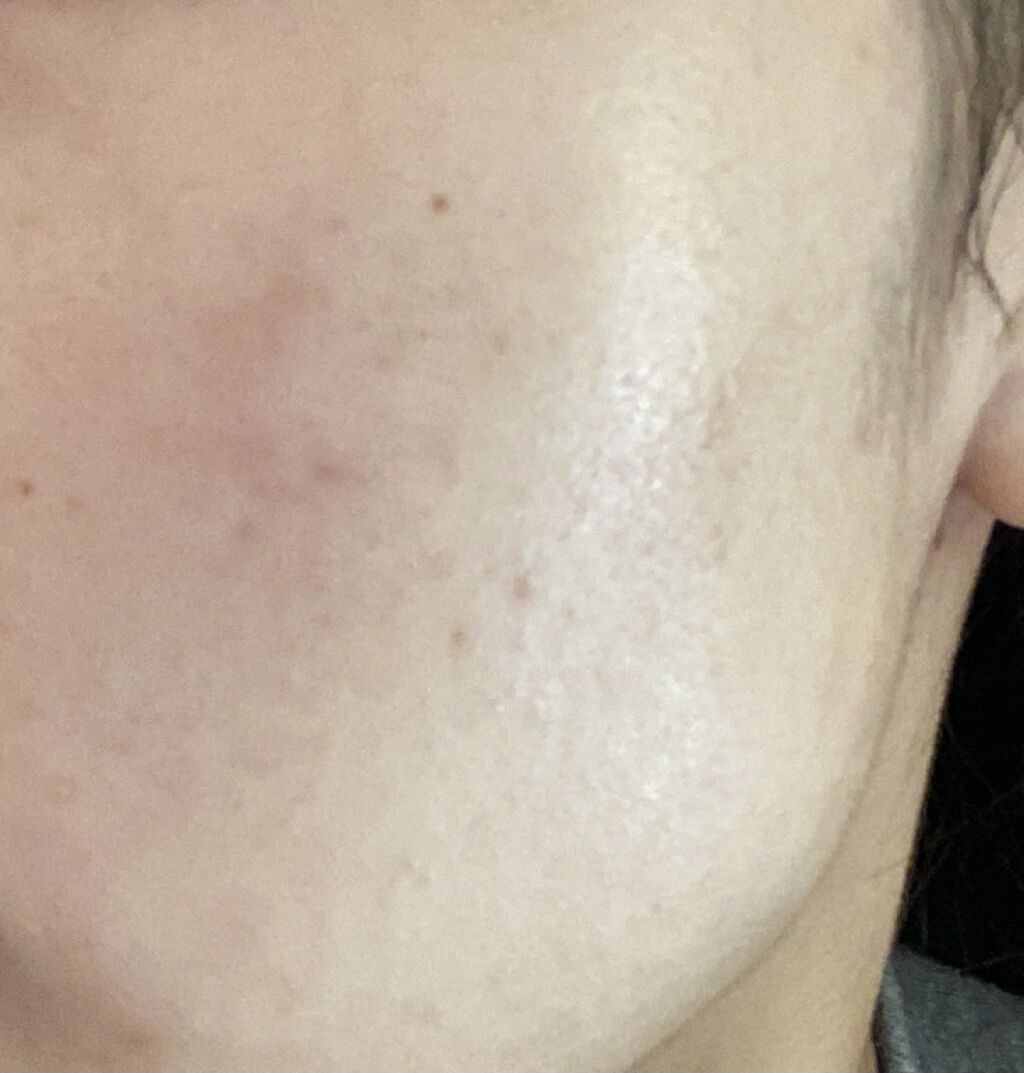 ディフェリンゲル0.1% /マルホ株式会社/その他を使ったクチコミ（2枚目）