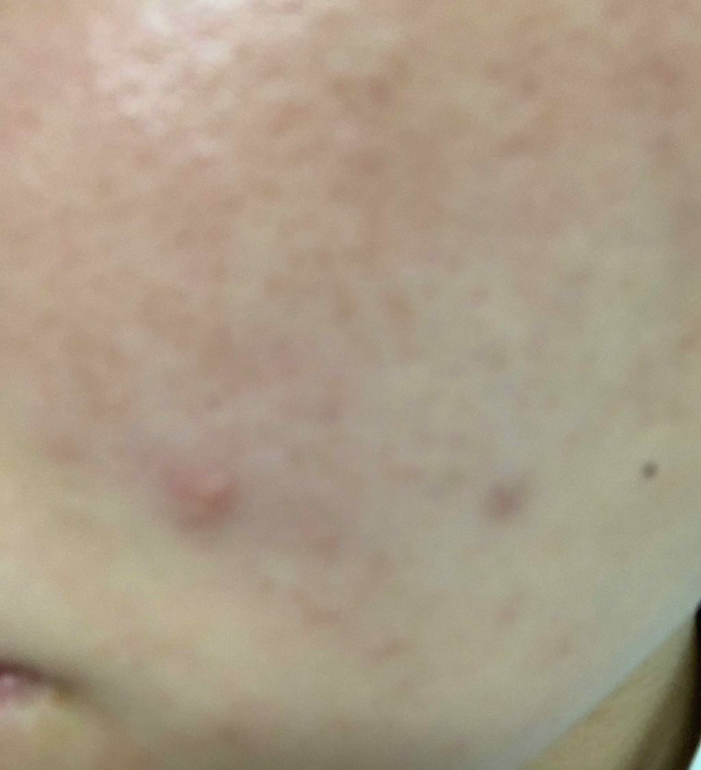 エピデュオゲル/マルホ株式会社/その他を使ったクチコミ（1枚目）