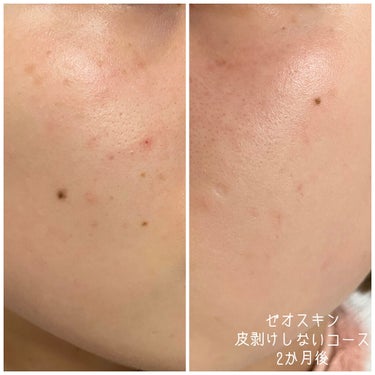 【試してみた】スキンブライセラム/ZO Skin Health | LIPS
