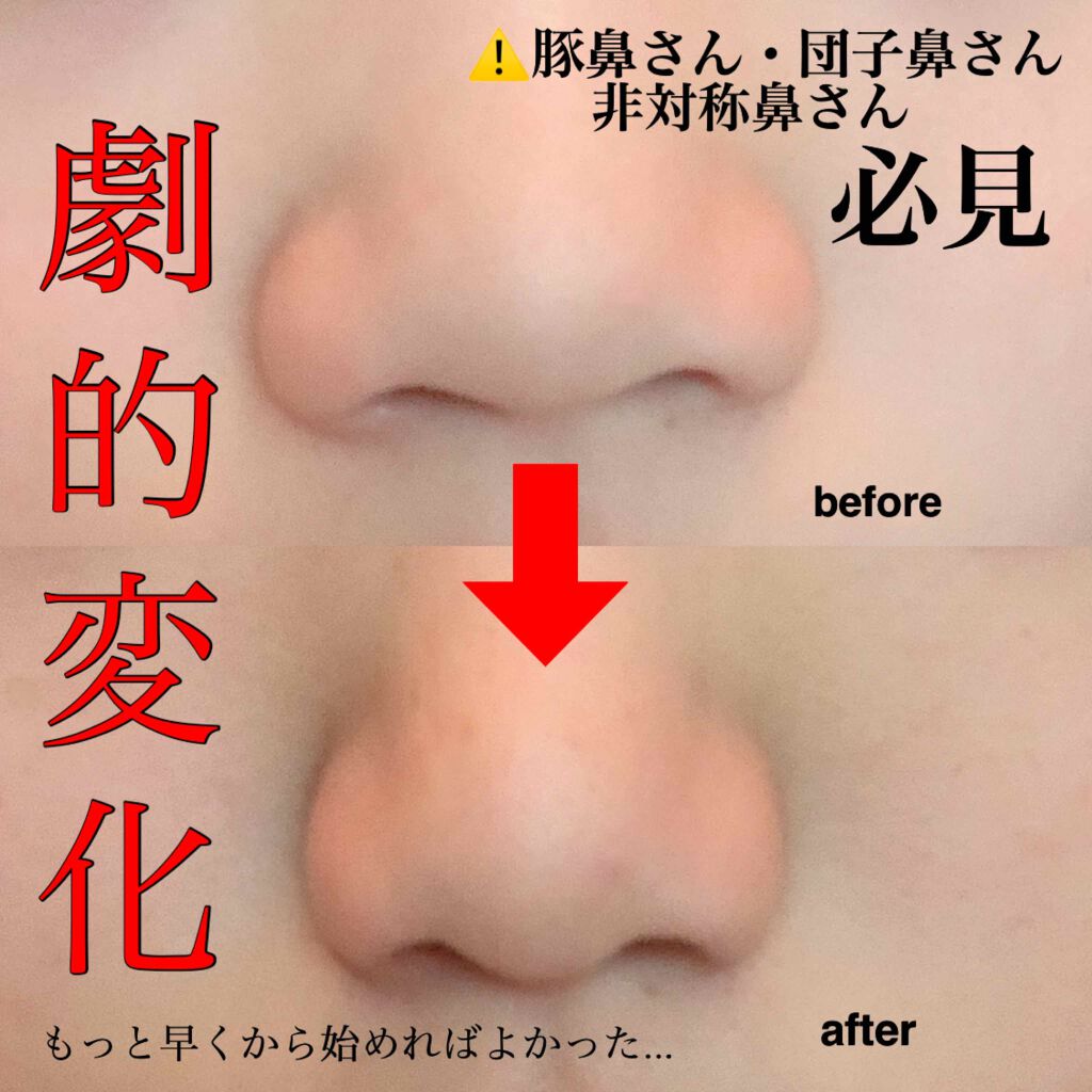Refa S Carat Refaを使った口コミ こんにちは 今回は私が1番コンプレックスに思っていた By Cher 普通肌 代前半 Lips Refa S Carat Refaを使った口コミ こんにちは 今回は私が1番コンプレックスに思っていた By Cher 普通肌 代前半 Lips
