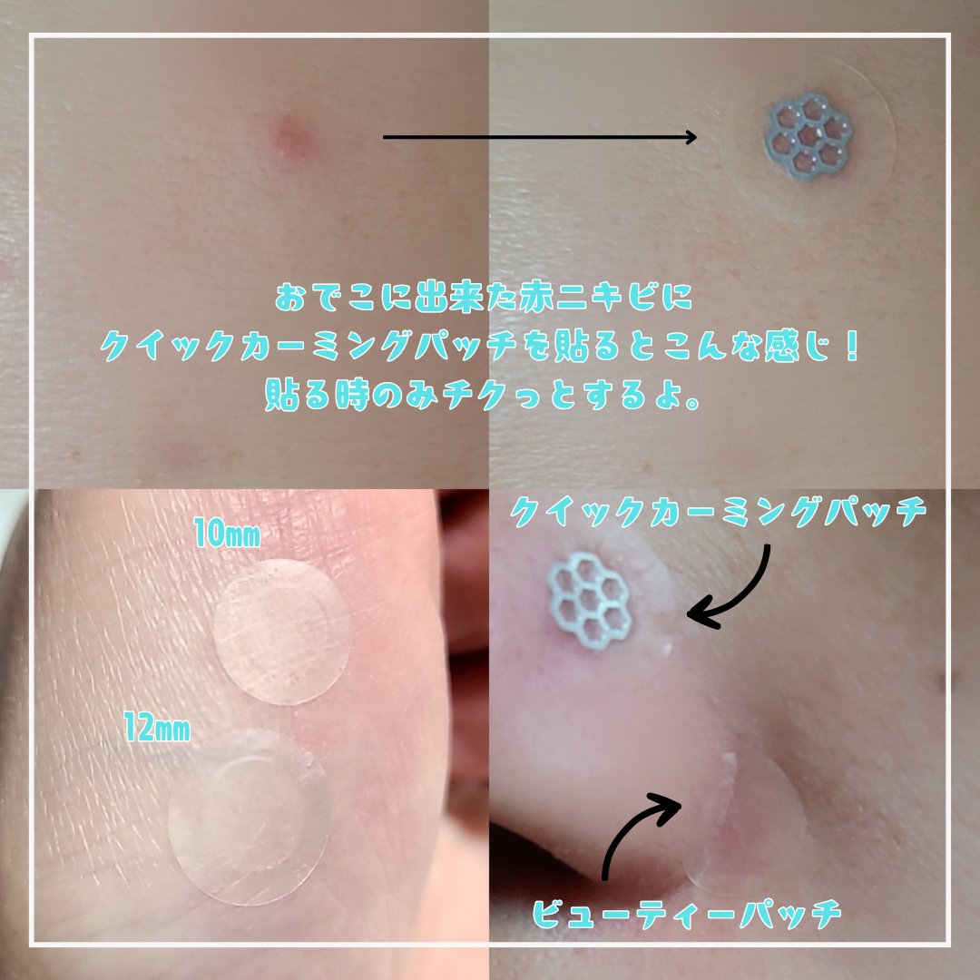 ビューティー スポットパッチ/イージーダムビューティー/にきびパッチを使ったクチコミ（2枚目）