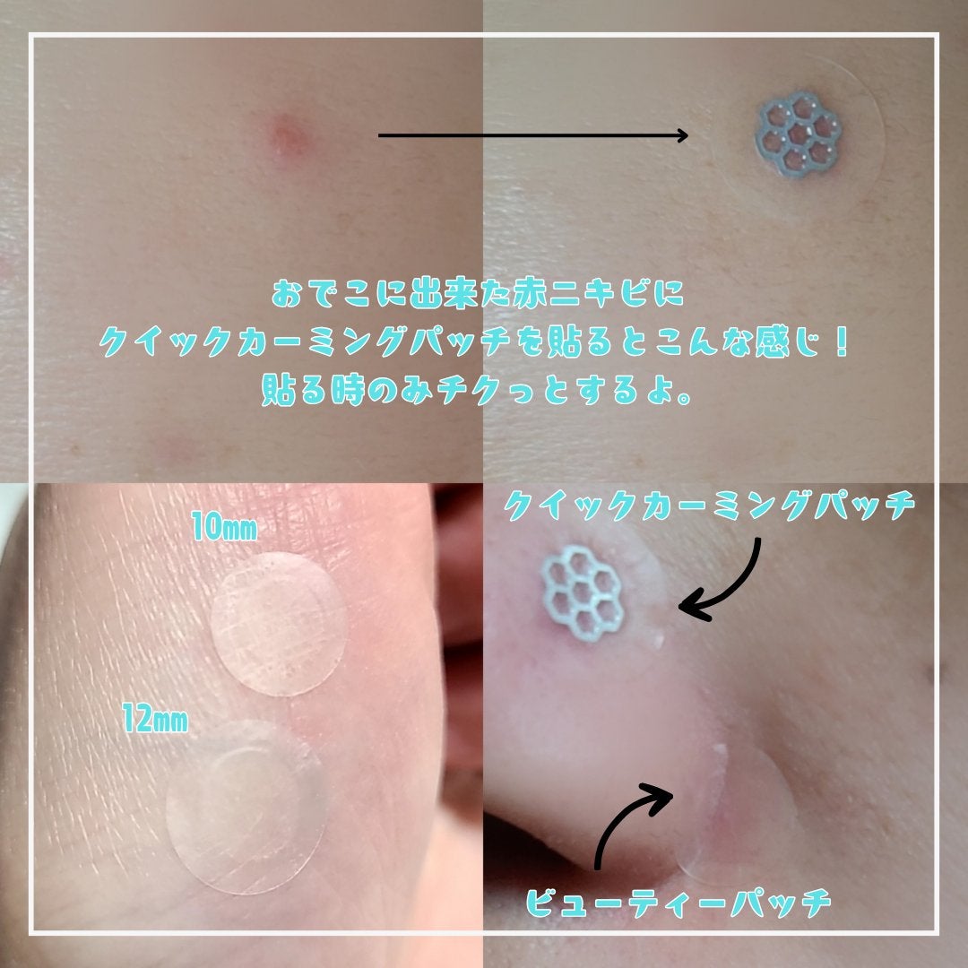 ビューティー スポットパッチ/イージーダムビューティー/にきびパッチを使ったクチコミ(2枚目)