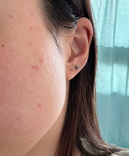 ニキビあとケアジェル/アットノン/その他スキンケアを使ったクチコミ(3枚目)