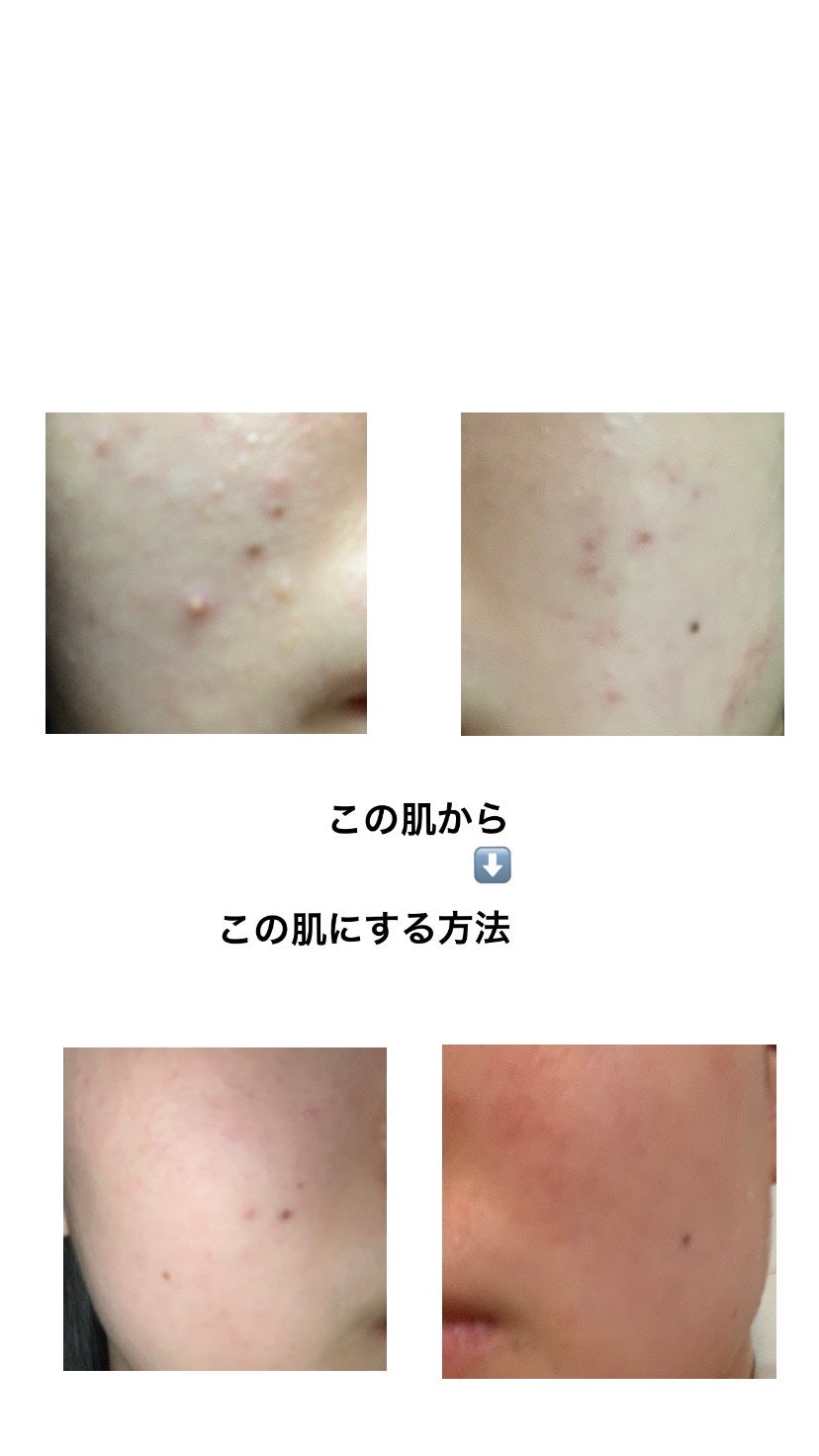 ロゼット洗顔パスタ アクネクリア/ロゼット/洗顔フォームを使ったクチコミ(1枚目)