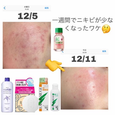 ETUDE ACC ピンクパウダー SPセットのクチコミ「⚠️ほんとに汚い肌ですごめんなさい🙇‍♀️
.
酷かったニキビ 毛穴がほぼ一週間で少なくなった.....」（1枚目）