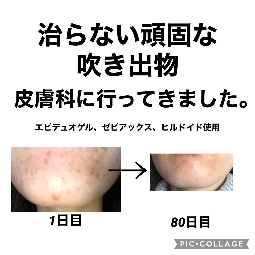 エピデュオゲル/マルホ株式会社/その他を使ったクチコミ（1枚目）