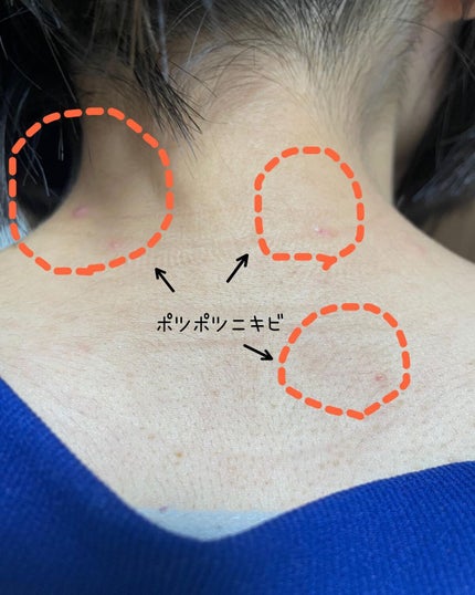 AHA·BHA·PHA 30デイズミラクルアクネボディクレンザー/SOME BY MI/ボディソープを使ったクチコミ(3枚目)