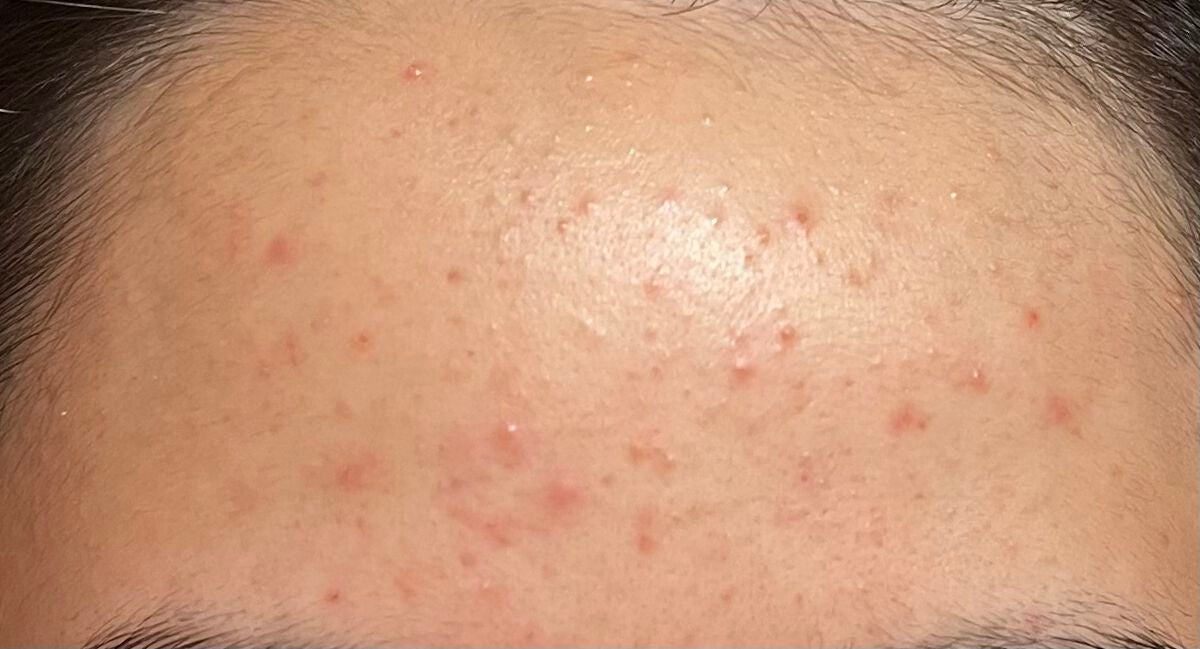 あぽろ on LIPS 「べピオゲル7日目旅行で4日ほどベピオゲルを塗らない期間があった..」(1枚目)