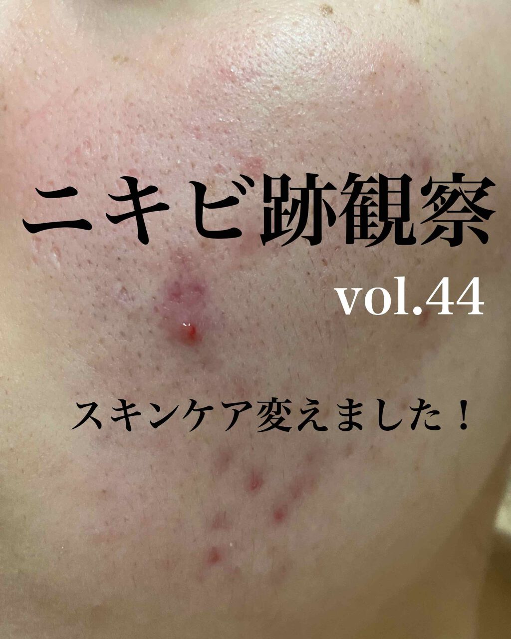 イオウカンフルローション(医薬品)/東豊薬品/その他を使ったクチコミ（1枚目）