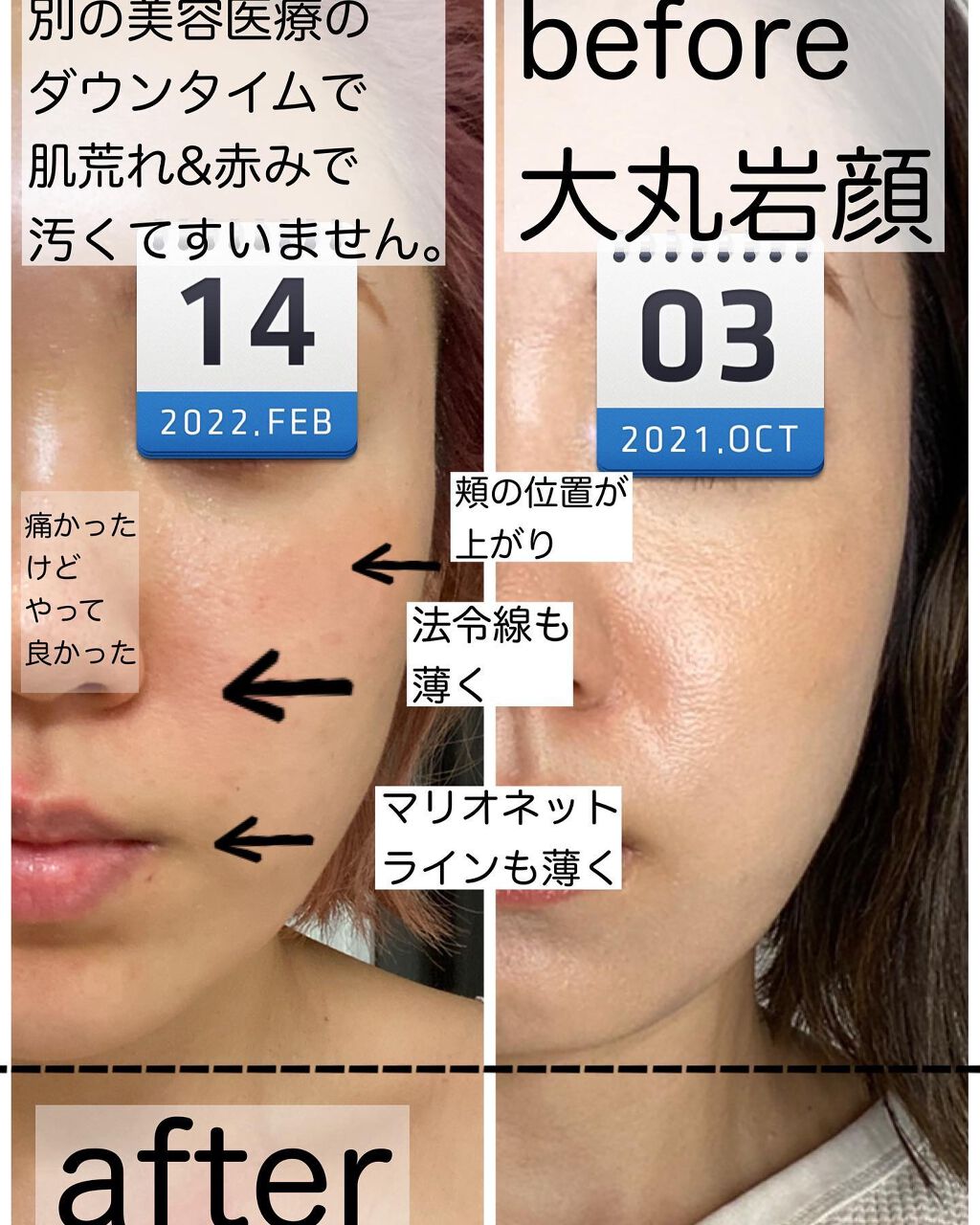 りっちゃん on LIPS 「やって良かった美容医療〜糸リフト編〜/年齢や昨今のマスク😷生..」(4枚目)