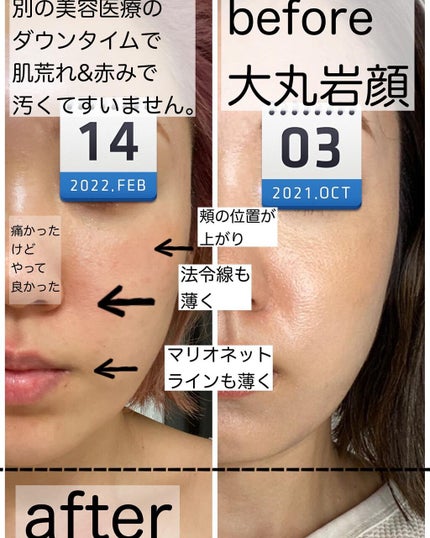 りっちゃん on LIPS 「やって良かった美容医療〜糸リフト編〜/年齢や昨今のマスク😷生..」(4枚目)