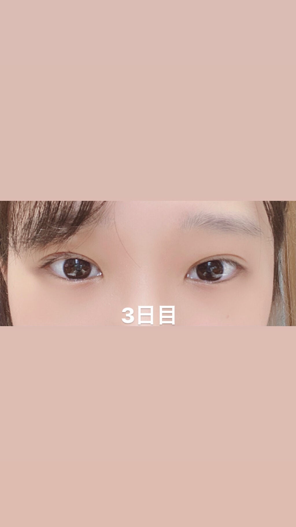 よちまる on LIPS 「二重の埋没法をしました!やってから1週間経ったので経過報告です..」(4枚目)