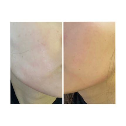 ぽむ on LIPS 「2023.9.13皮膚科に受診 エピデュオとヘパリン処方1枚目..」(4枚目)