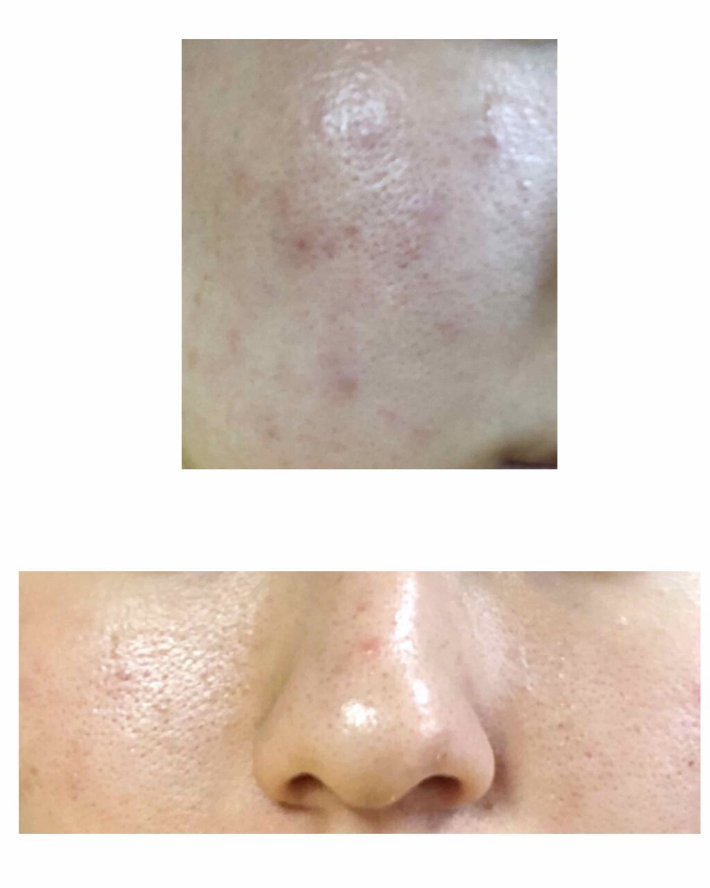 berry_618 on LIPS 「どなたか助けてください🙏🏻《ニキビ・毛穴・黒ずみについて》小学..」(2枚目)