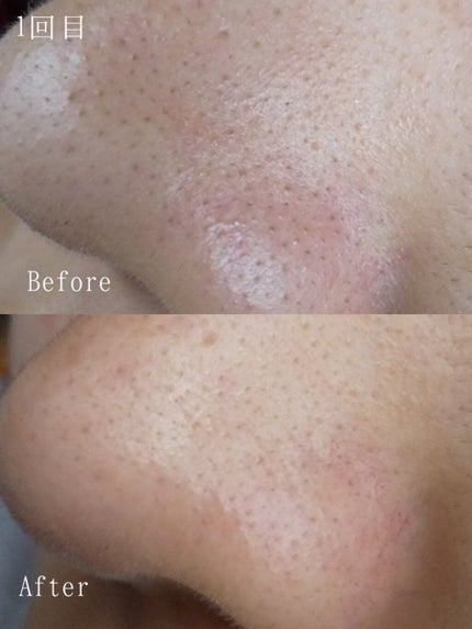 ノーモアブラックヘッド(ノーズピーリング)/One-day's you/スクラブ・ゴマージュを使ったクチコミ(2枚目)