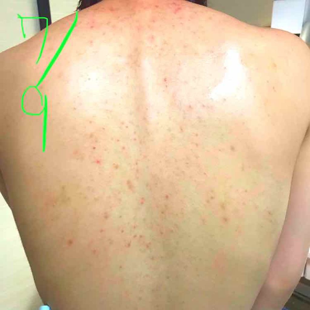 ニキビを防ぐ薬用石鹸 Forback ペリカン石鹸を使った口コミ 背中ニキビケア 私の背中ニキビのケアを始め By ピタ子 敏感肌 代前半 Lips