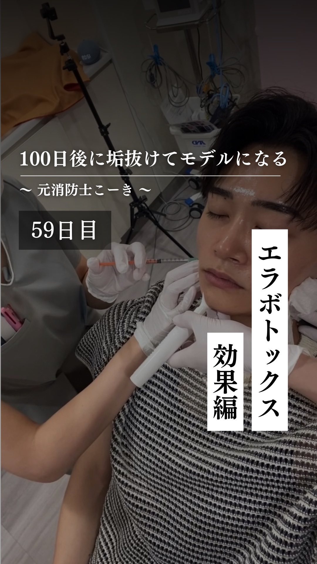 @kooki_mensskincare ◀︎100日後にモデルになる男

✨59日目 エラボトックス 効果編✨

7月の後半にエラボト打って
約1ヶ月経ちました。

エラに注目してみると
結構変わってませんか？？

エラボトックスが気になる