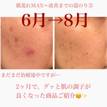 こんにちは😊
肌荒れMAX〜改善まで道のり
今回は使用した途端、ぐっと肌荒れが
改善された商品をご紹介します😳✨

まだまだ完全な肌ではないのですが、
ボロボロだった頃と比べると
良くなってきたかな？と