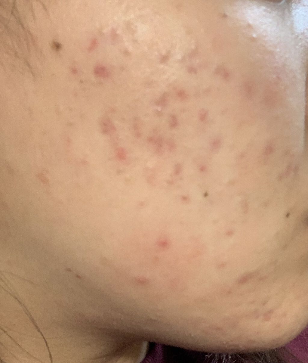 クリンダマイシンゲル(医薬品)/クラシエ薬品/その他を使ったクチコミ（1枚目）