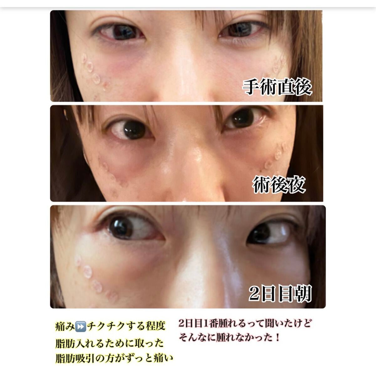 【旧】ディオールスキン フォーエヴァー スキン コレクト コンシーラー/Dior/リキッドコンシーラーを使ったクチコミ(2枚目)