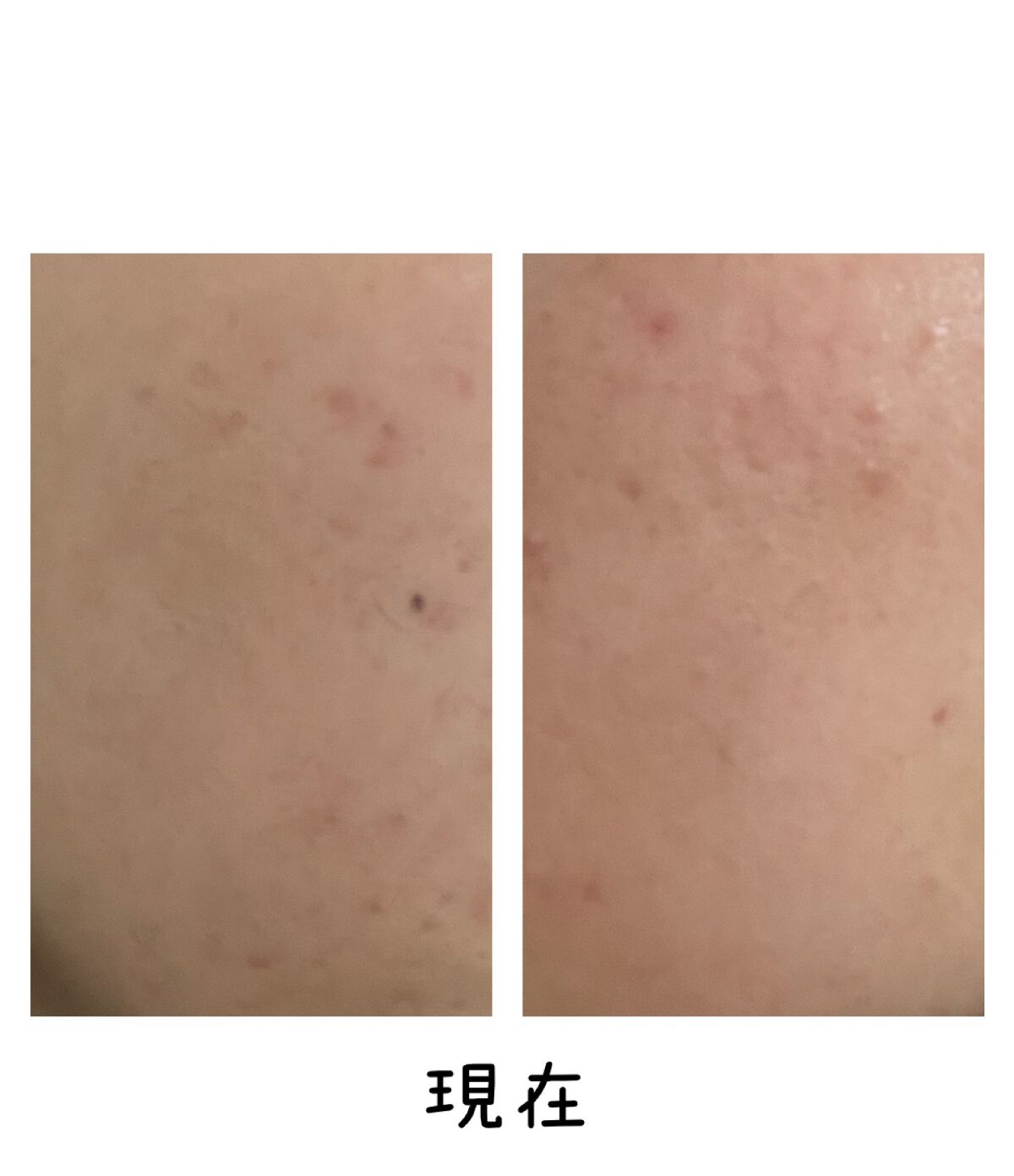 ドクダミ80％スージングアンプル/Anua/美容液を使ったクチコミ（3枚目）