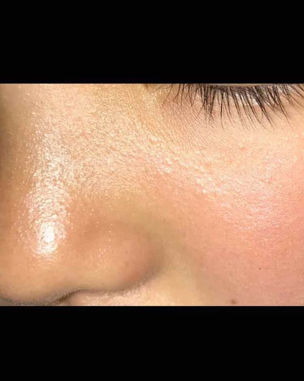 m.yura on LIPS 「写真はノーマスです少し前から鼻やほっぺた、顎、おでこなどにブツ..」(3枚目)