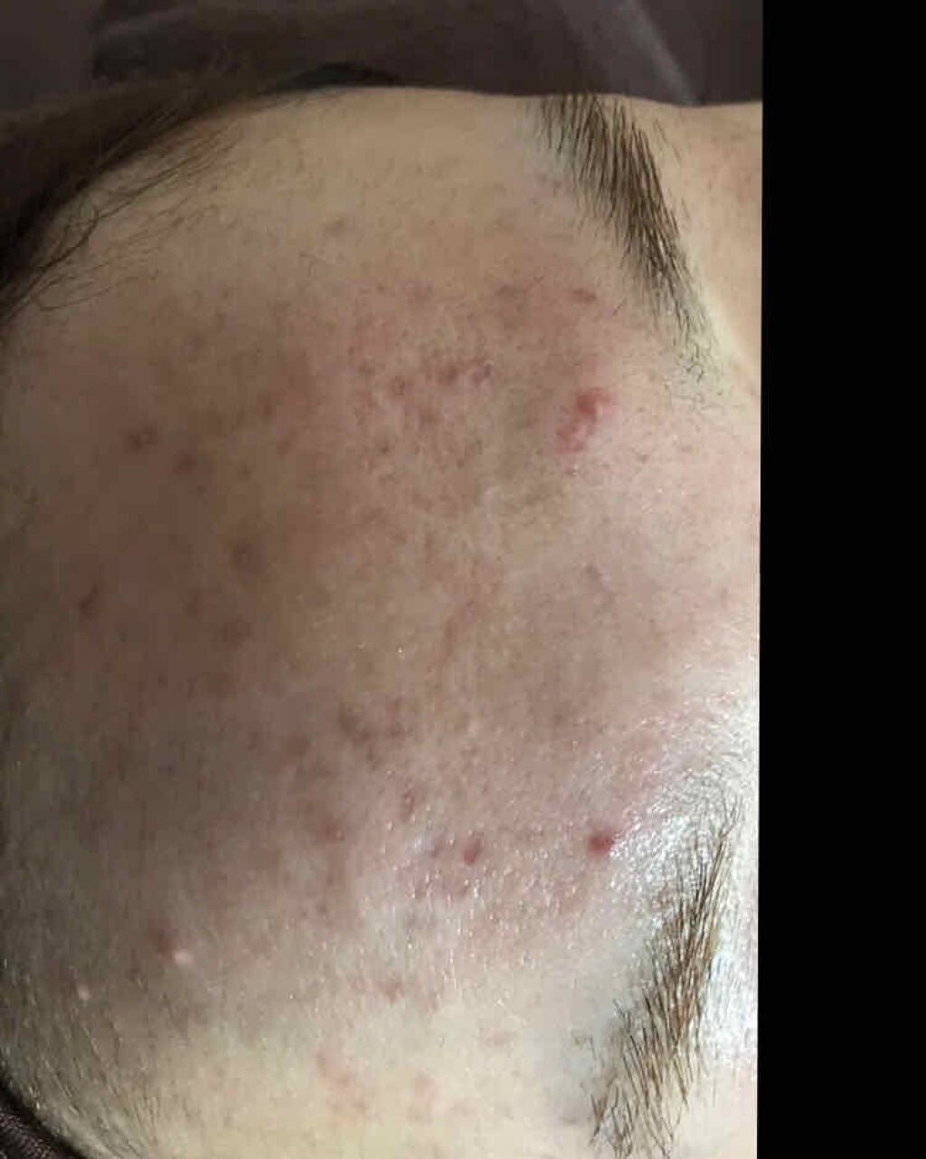 薬用3ステップセット30日サイズ/プロアクティブ/トライアルキットを使ったクチコミ(3枚目)