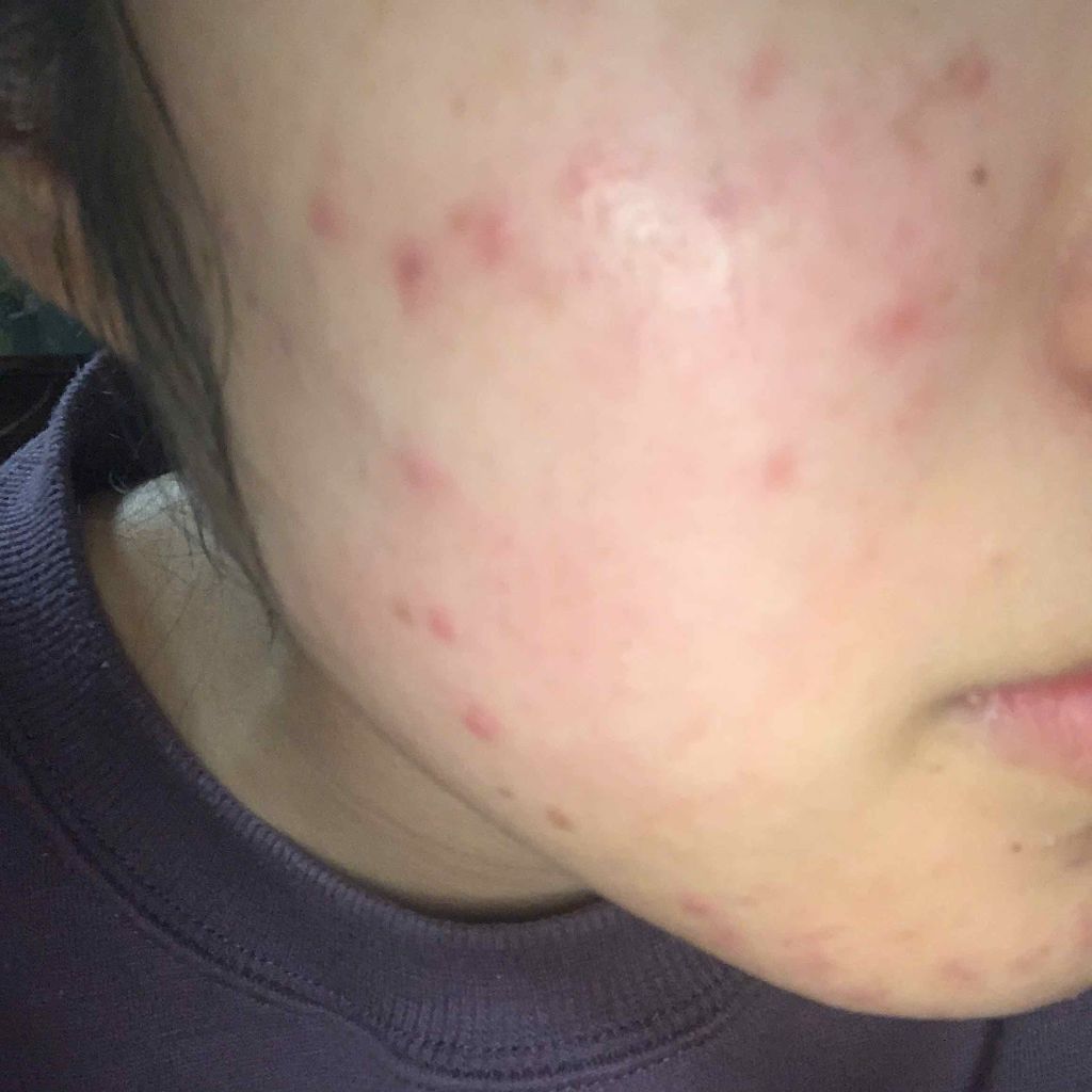 sparkle_lips_i2z6 on LIPS 「ほんとに助けてください…18歳の高3ですニキビがずっと出来て困..」(3枚目)