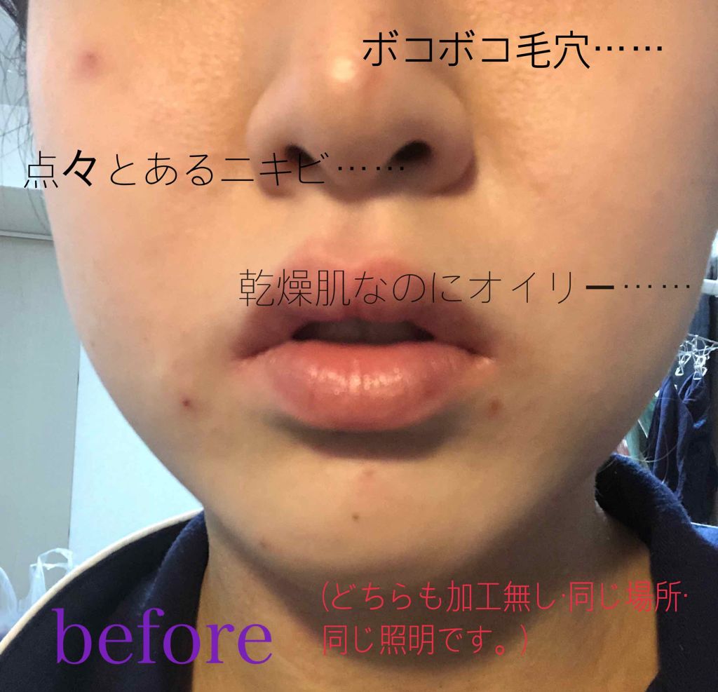 ニキビを防ぐ薬用石鹸 ForBack/ペリカン石鹸/ボディ石鹸を使ったクチコミ（2枚目）