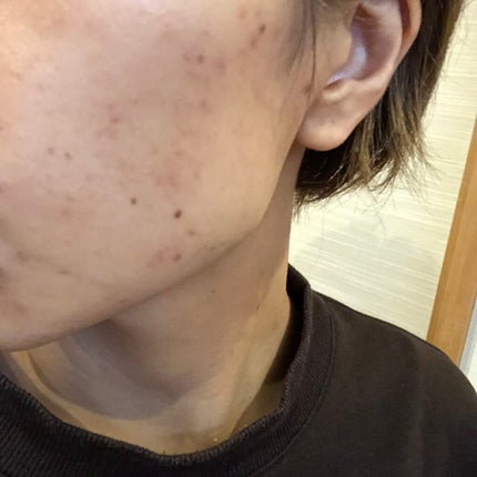 チョコラBB ルーセントC(医薬品)/チョコラBB/その他を使ったクチコミ(2枚目)