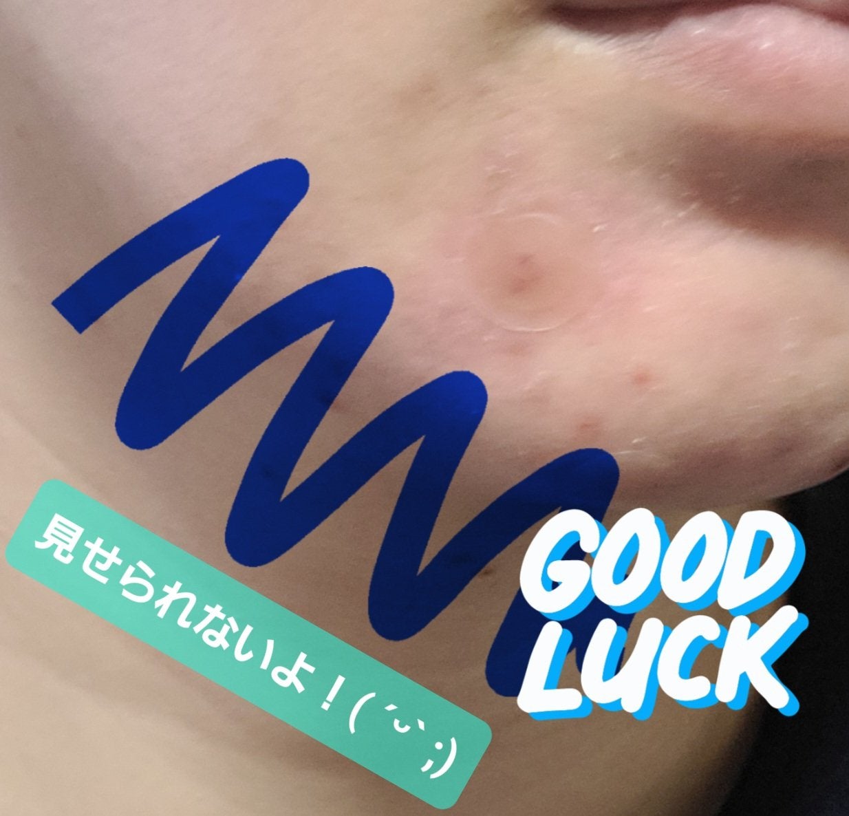 ゼロスポットパッチ/Today’s Cosme/にきびパッチを使ったクチコミ(3枚目)