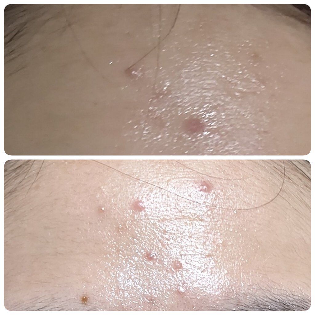 ニキビあとケアジェル/アットノン/その他スキンケアを使ったクチコミ（2枚目）