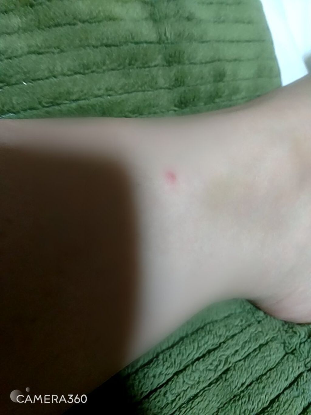 マキロン かゆみ止め液(医薬品)/マキロン/その他を使ったクチコミ(4枚目)