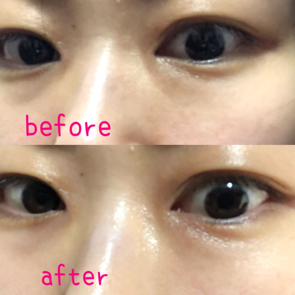 MICRO NEED ヒアルロン酸 セラムパッチ/bijoːu(ビジュー)MICRO NEED/シートマスク・パックを使ったクチコミ（3枚目）