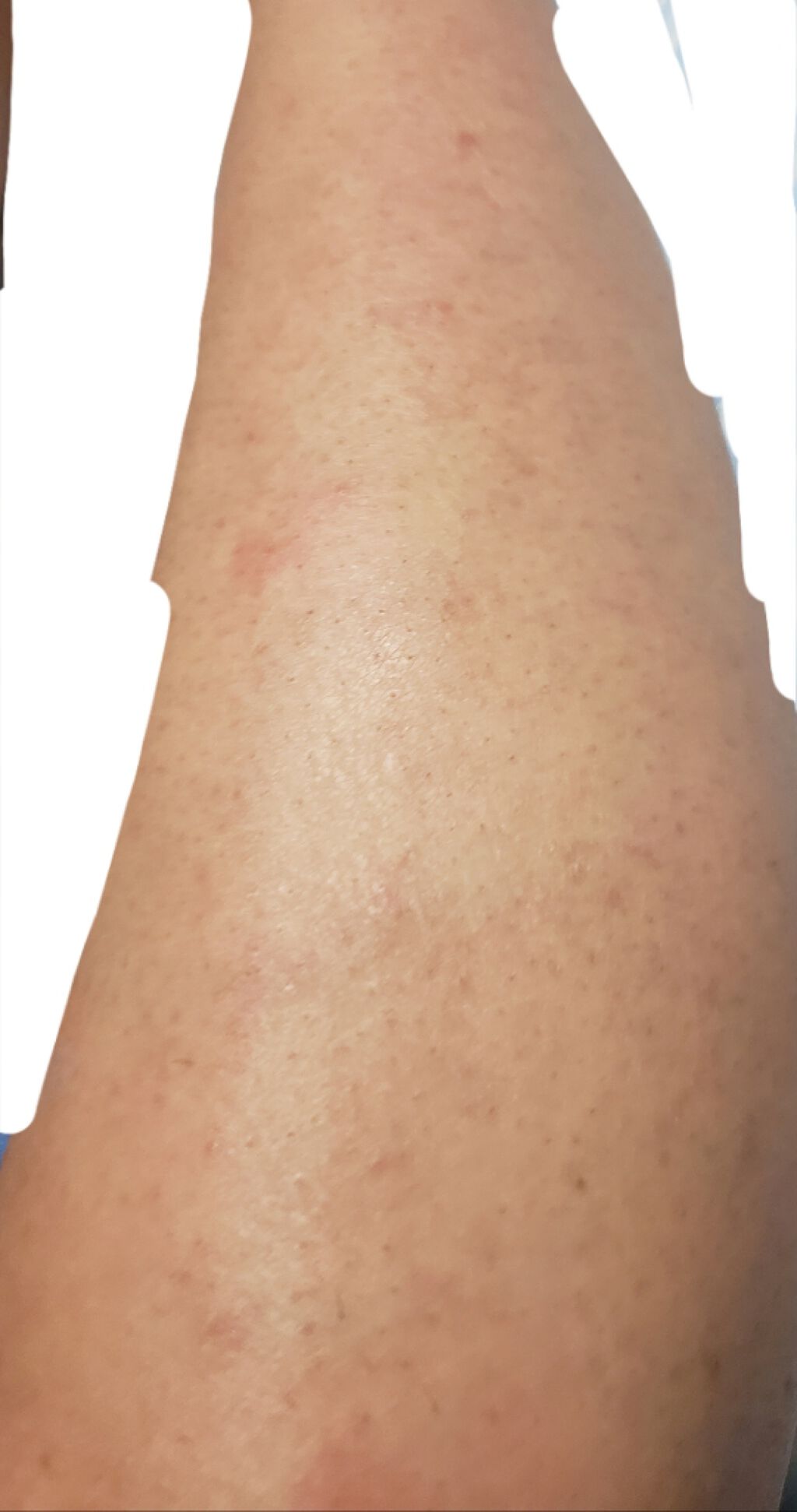 除毛クリームキット敏感肌用/エピラット/除毛クリームを使ったクチコミ（2枚目）