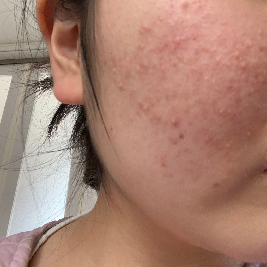 ちひろ on LIPS 「ーニキビ日記6ヶ月7日目ーこんにちは😃最近本当に肌は乾燥気味で..」(1枚目)