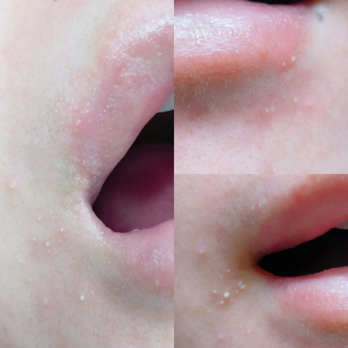 敏感肌な研究者💊あすか💊 on LIPS 「久しぶりの大爆発😭小さいアイツらが現れました今回は事の経緯をご..」(2枚目)