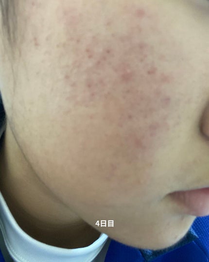 白色ワセリン(医薬品)/健栄製薬/その他を使ったクチコミ(5枚目)