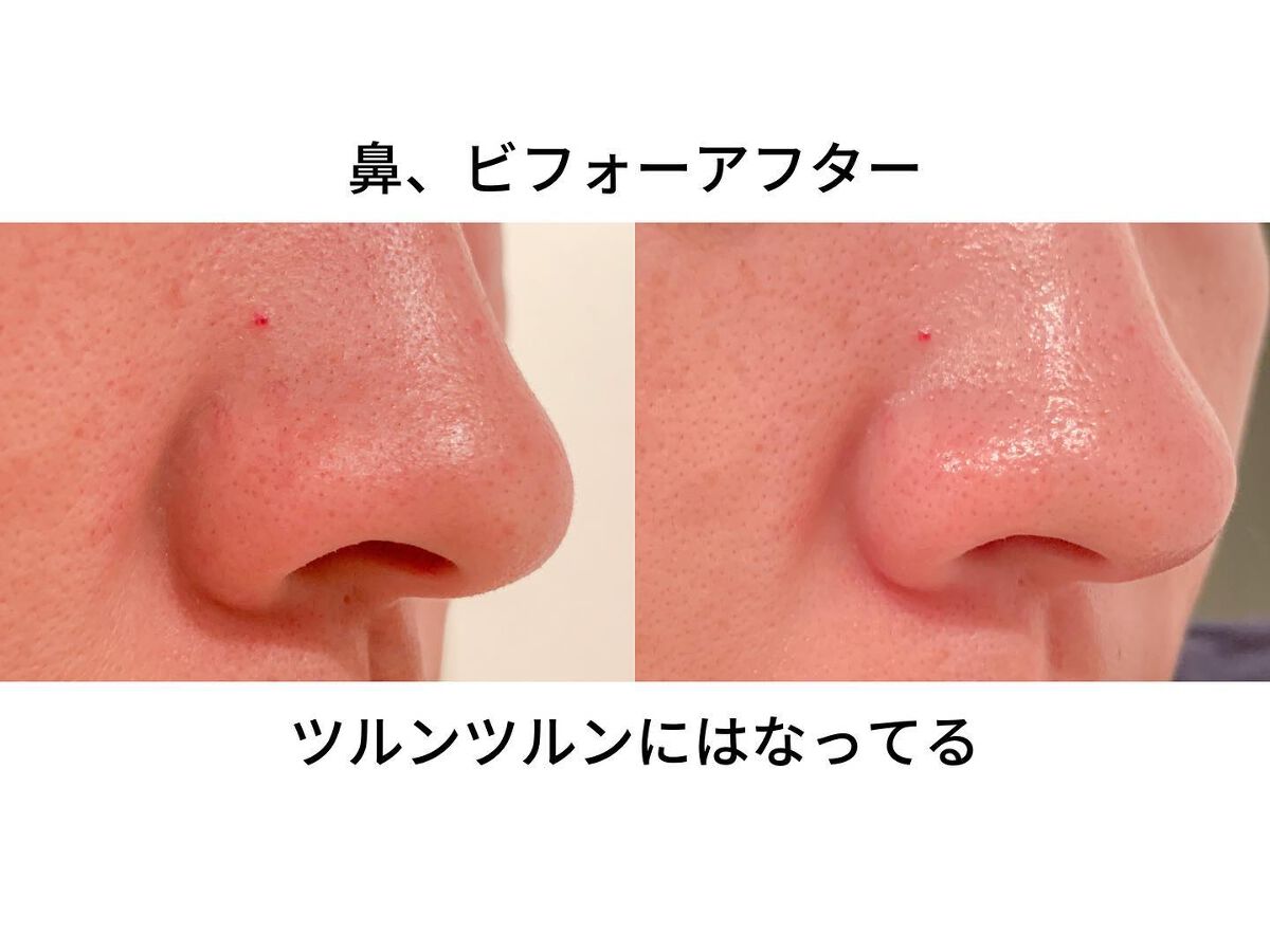 クリーニングリキッド/ツルリ/化粧水を使ったクチコミ（3枚目）