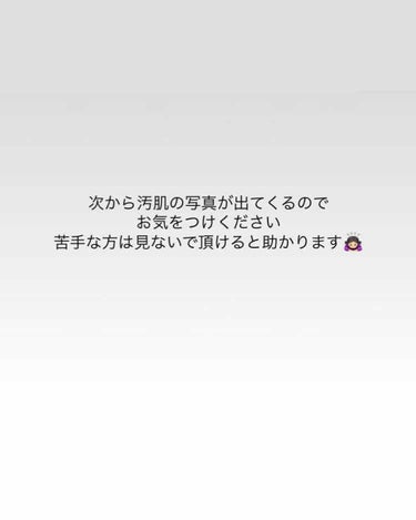 ずっと読む専門だったのですが投稿してみます。お目汚し失礼致します。
前半身の上話ですので💎まで飛ばしていただいて大丈夫です。

たぶん高校生くらいからニキビが出来始め、今20代前半ですがずっと悩み続けて